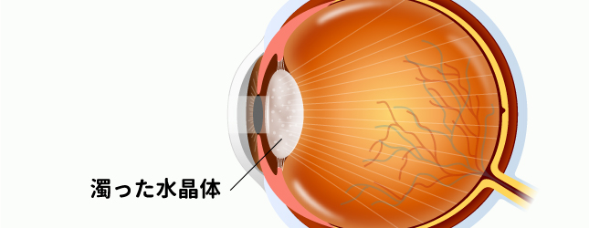 白内障（日帰り手術）について