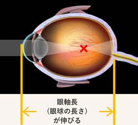 近視の眼